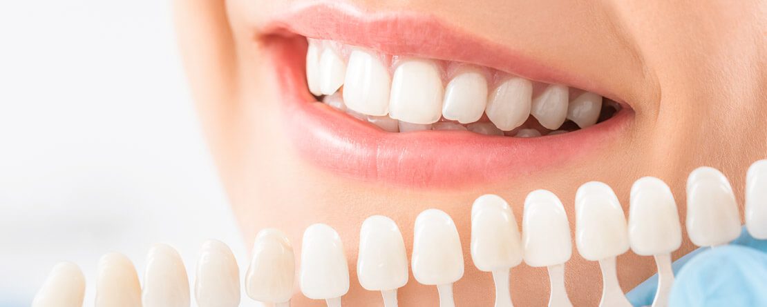 Optimizing Your Smile with Ceramic Veneers